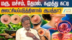 மரு, மச்சம், தேமல், கழுத்து கட்டிகளை அலட்சியப்படுத்தினால் ஆபத்தா?