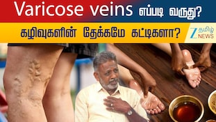 Varicose veins எப்படி வருது ? கழிவுகளின் தேக்கமே கட்டிகளா ?